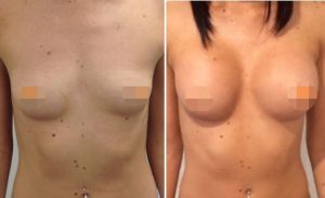 Breast Augmentation CosMediTour