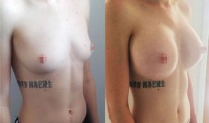 Breast Augmentation CosMediTour