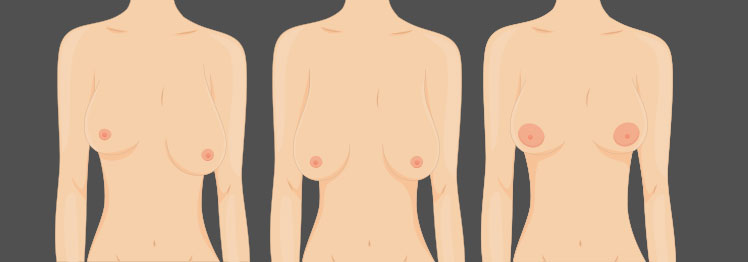 Correcting Uneven Breasts: Surgical Solutions for Breast Asymmetry