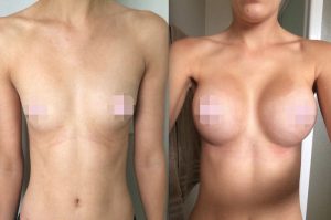 Breast Augmentation CosMediTour