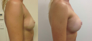 Breast Augmentation CosMediTour Phuket