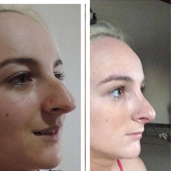 nose contour surgery