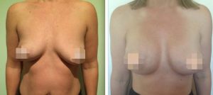 Breast Augmentation CosMediTour