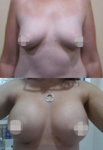 Breast Augmentation CosMediTour