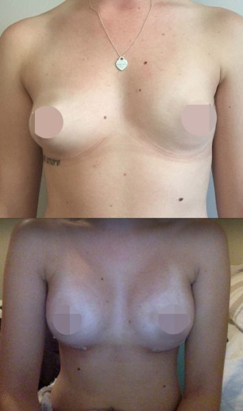 Breast Augmentation CosMediTour