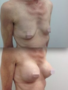 Breast Augmentation CosMediTour