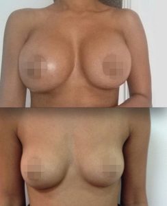 Breast Augmentation CosMediTour