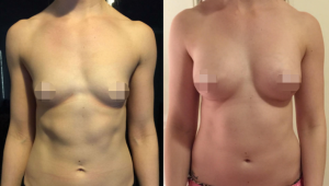 Breast Augmentation CosMediTour