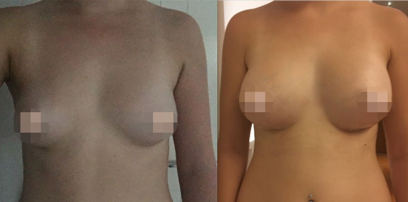 Breast Augmentation CosMediTour