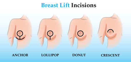 Breast Reduction Or Breast Lift?