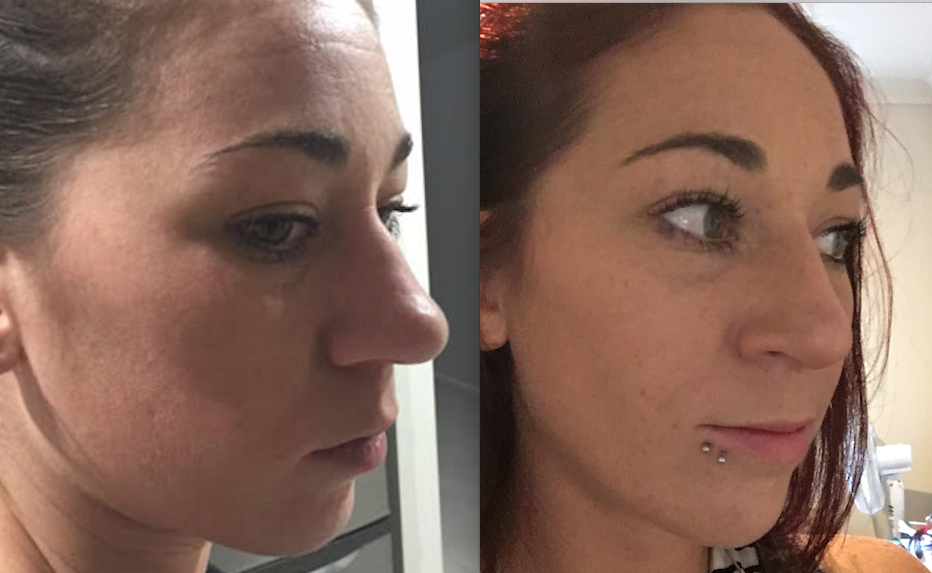 Bangkok Rhinoplasty Results