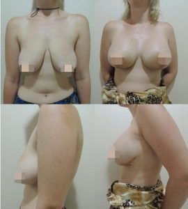 Breast Lift CosMediTour