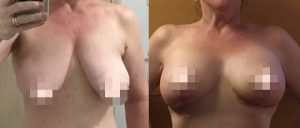 Breast Lift CosMediTour