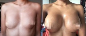 Breast Augmentation CosMediTour