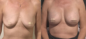 Breast Augmentation CosMediTour