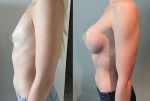 Breast Augmentation CosMediTour