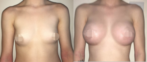 Breast Augmentation CosMediTour