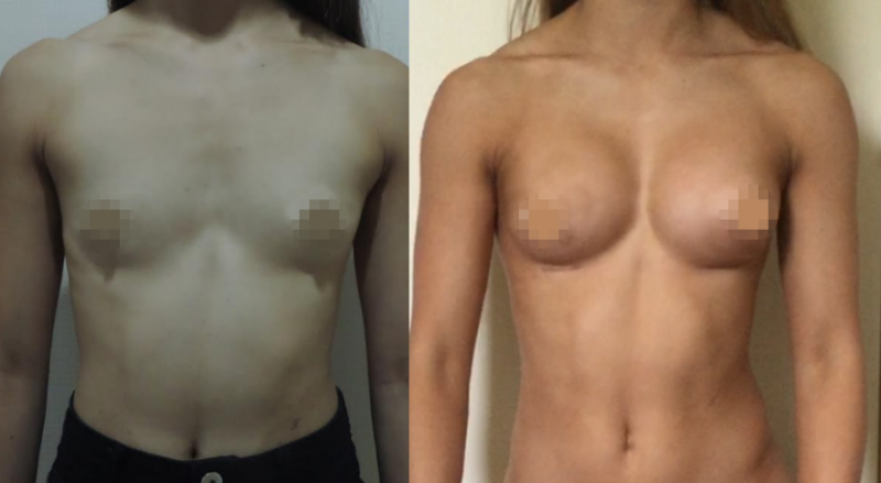 Breast Augmentation CosMediTour