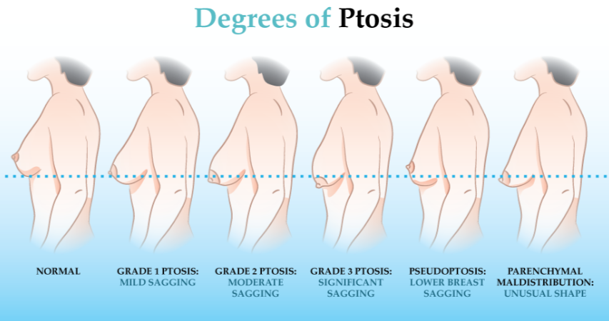 Breast ptosis : severity, causes and treatment