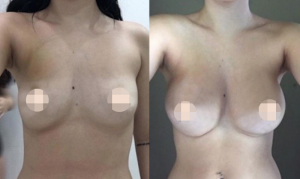 Breast Augmentation CosMediTour