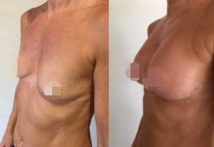 Breast Augmentation CosMediTour