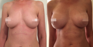 Breast Augmentation CosMediTour