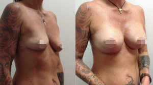 Breast Augmentation CosMediTour