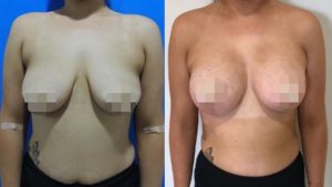 Breast Augmentation CosMediTour