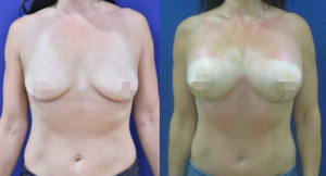 Breast Augmentation CosMediTour