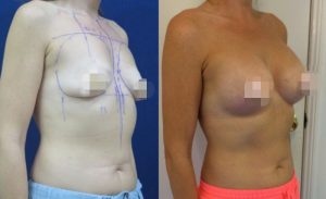 Breast Augmentation CosMediTour