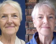 Facelift - Before and after photo