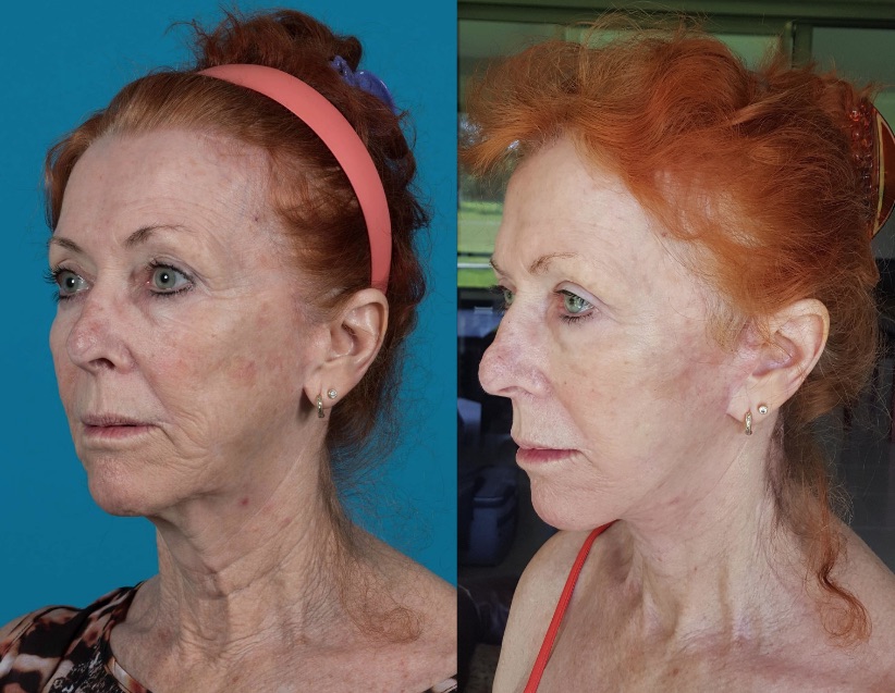 before and after tummy tuck on a 67 year old woman