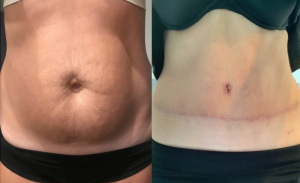 Tummy Tuck Dr Kamolwan