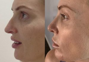 Corine's rhinoplasty result