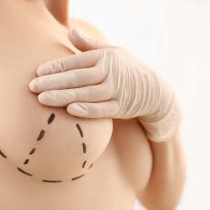 Woman after a Boob Job or Breast Augmentation in Thailand with Breast Implants