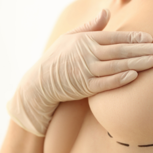 Woman after a Boob Job or Breast Augmentation in Thailand with Breast Implants