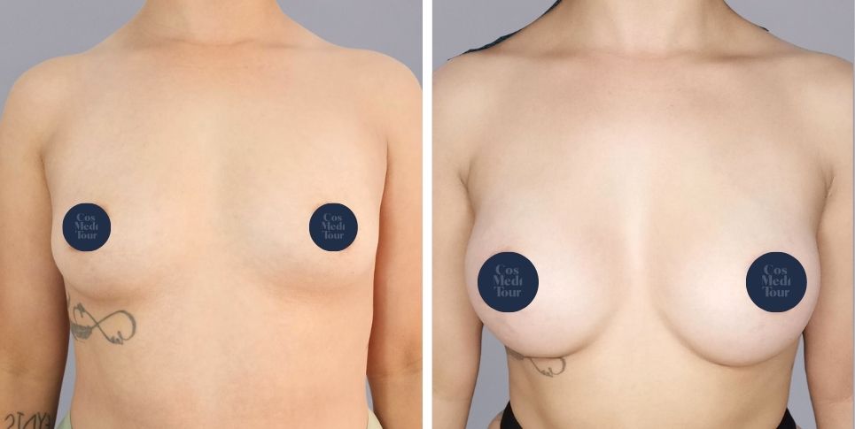 Breast Augmentation boob job before and after photo